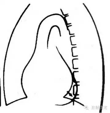 心脏常见疾病的X线诊断