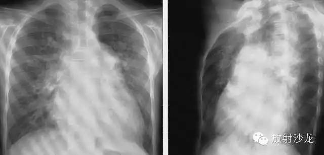 心脏常见疾病的X线诊断