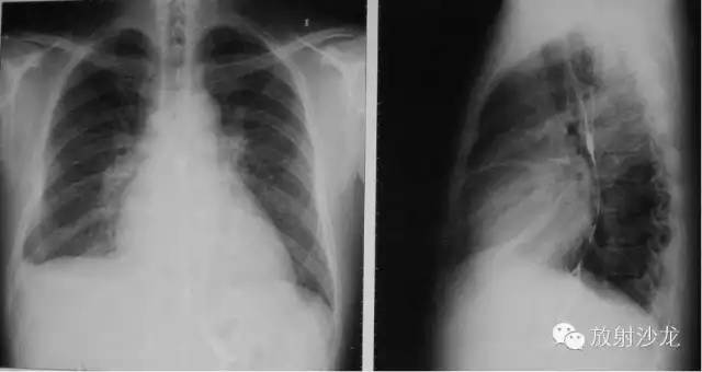 心脏常见疾病的X线诊断