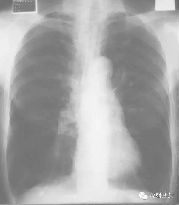 心脏常见疾病的X线诊断