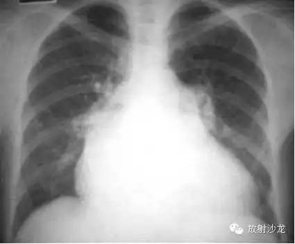 心脏常见疾病的X线诊断