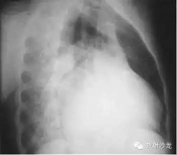 心脏常见疾病的X线诊断