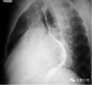 心脏常见疾病的X线诊断