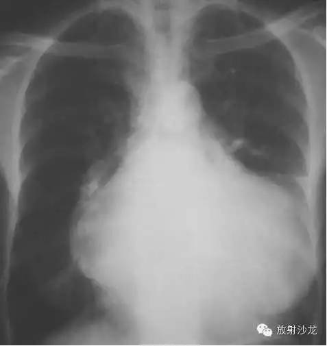 心脏常见疾病的X线诊断