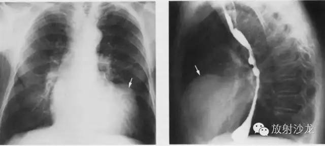 心脏常见疾病的X线诊断