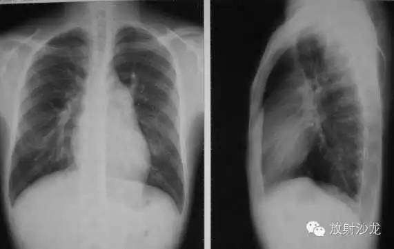 心脏常见疾病的X线诊断