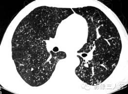 肺内粟粒状小结节的鉴别诊断 肺内粟粒状小结节的鉴别诊断