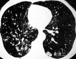 肺内粟粒状小结节的鉴别诊断 肺内粟粒状小结节的鉴别诊断