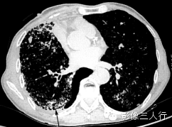 肺内粟粒状小结节的鉴别诊断 肺内粟粒状小结节的鉴别诊断