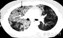 肺内粟粒状小结节的鉴别诊断 肺内粟粒状小结节的鉴别诊断