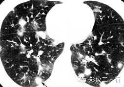 肺内粟粒状小结节的鉴别诊断 肺内粟粒状小结节的鉴别诊断