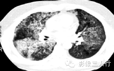 肺内粟粒状小结节的鉴别诊断 肺内粟粒状小结节的鉴别诊断