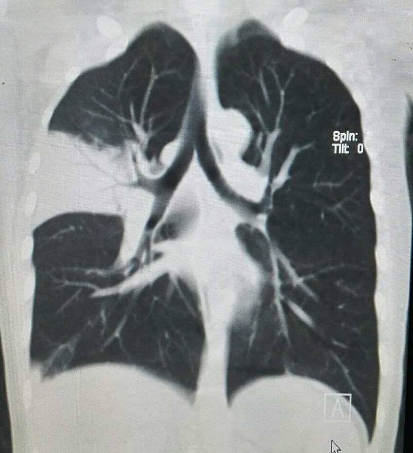 【病例】大叶性肺炎1例CT影像表现 【病例】大叶性肺炎1例CT影像表现