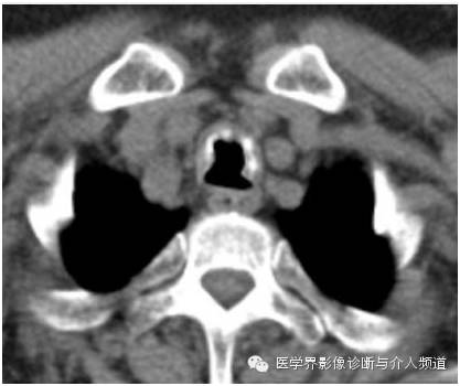 【病例】骨化性气管支气管病1例CT影像表现 【病例】骨化性气管支气管病1例CT影像表现