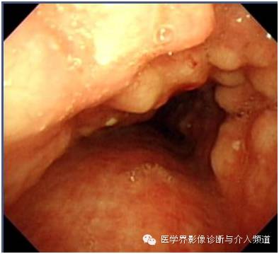 【病例】骨化性气管支气管病1例CT影像表现 【病例】骨化性气管支气管病1例CT影像表现