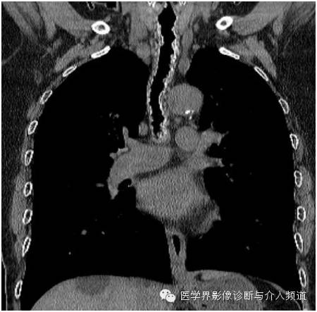 【病例】骨化性气管支气管病1例CT影像表现 【病例】骨化性气管支气管病1例CT影像表现