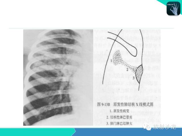 【PPT】肺结核影像学诊断