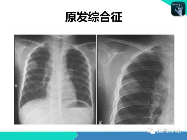 【PPT】肺结核影像学诊断