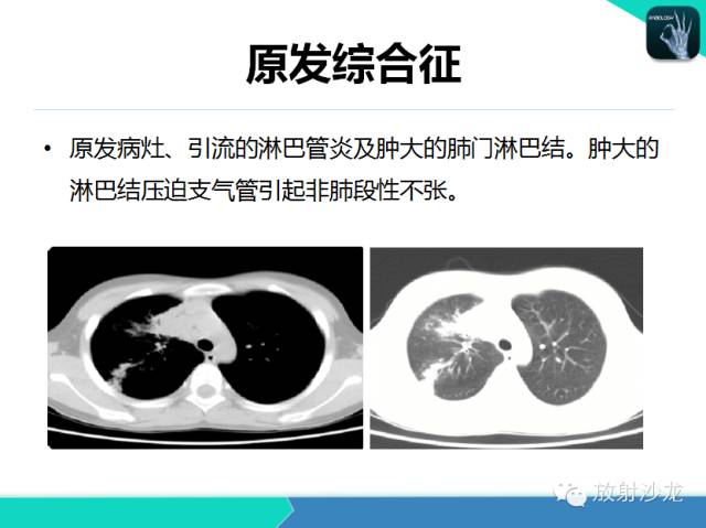 【PPT】肺结核影像学诊断