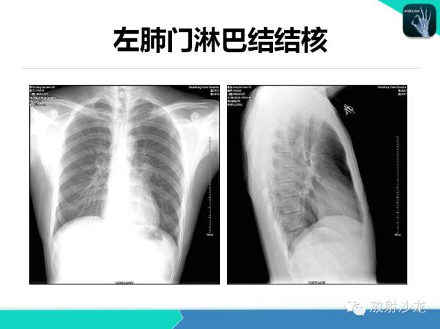 【PPT】肺结核影像学诊断