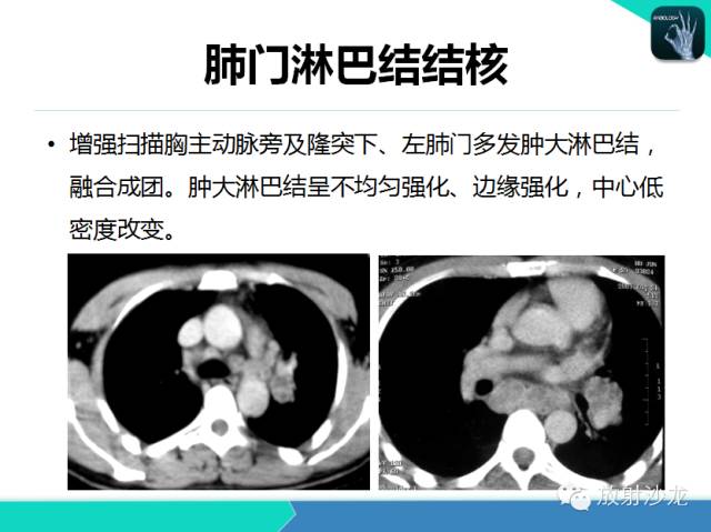 【PPT】肺结核影像学诊断