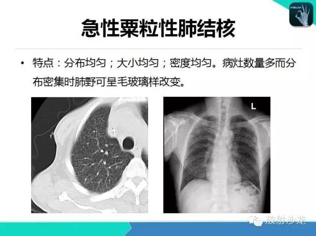 【PPT】肺结核影像学诊断