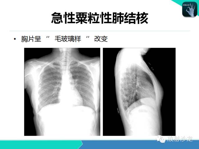 【PPT】肺结核影像学诊断