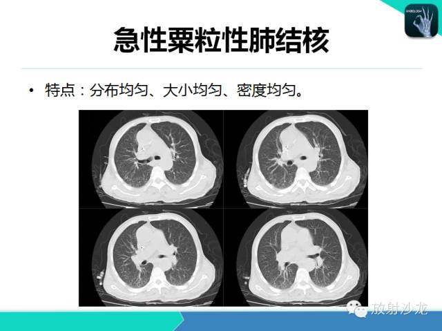 【PPT】肺结核影像学诊断