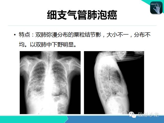 【PPT】肺结核影像学诊断