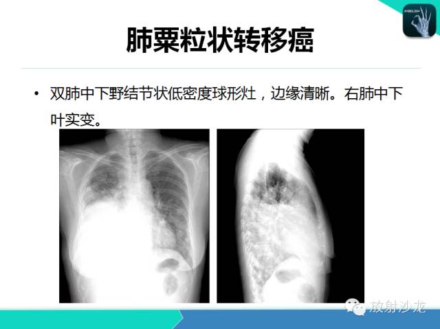 【PPT】肺结核影像学诊断
