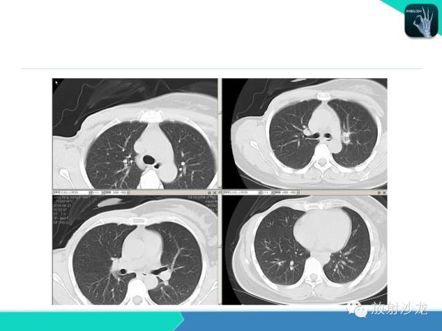 【PPT】肺结核影像学诊断