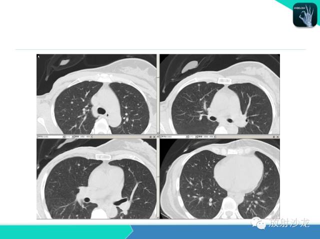 【PPT】肺结核影像学诊断