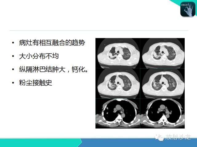 【PPT】肺结核影像学诊断