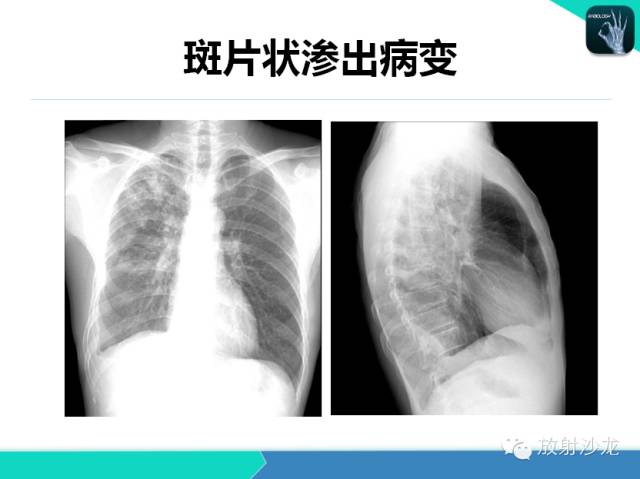 【PPT】肺结核影像学诊断