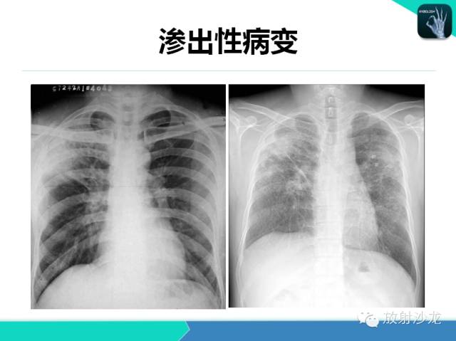 【PPT】肺结核影像学诊断