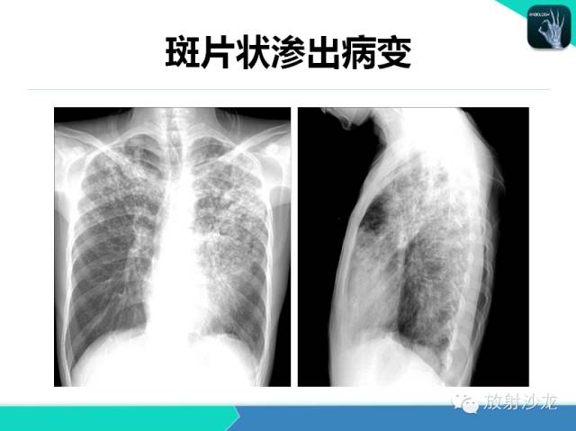 【PPT】肺结核影像学诊断