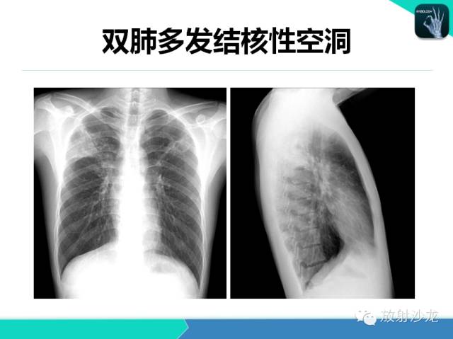 【PPT】肺结核影像学诊断