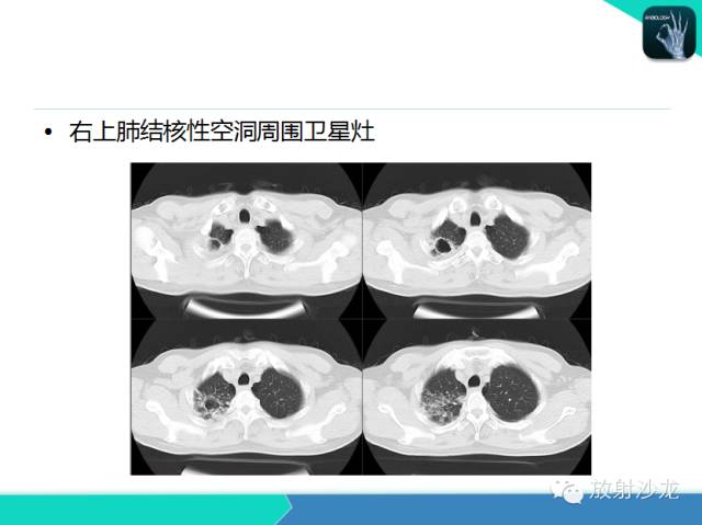 【PPT】肺结核影像学诊断