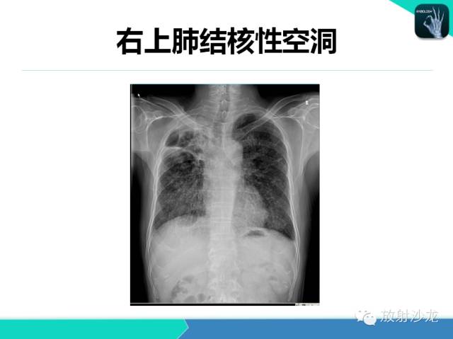 【PPT】肺结核影像学诊断