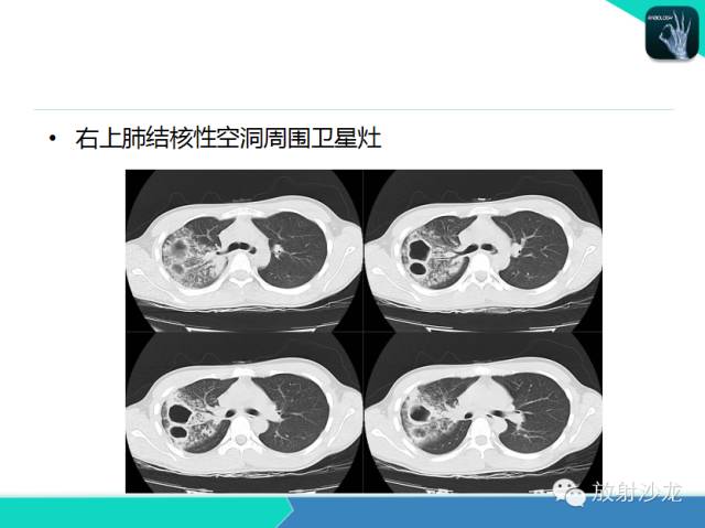 【PPT】肺结核影像学诊断