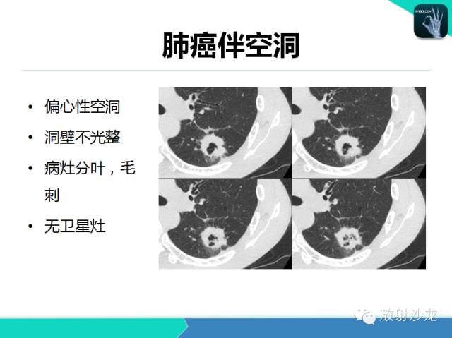 【PPT】肺结核影像学诊断