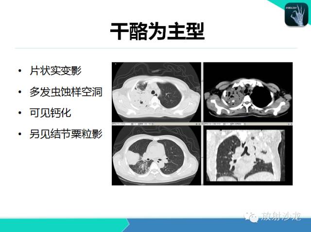 【PPT】肺结核影像学诊断