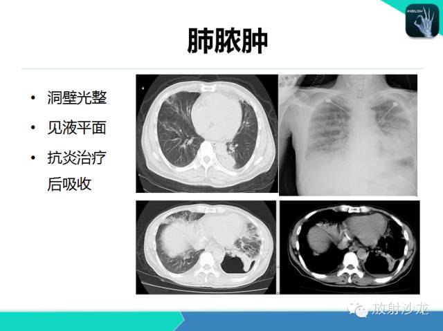 【PPT】肺结核影像学诊断