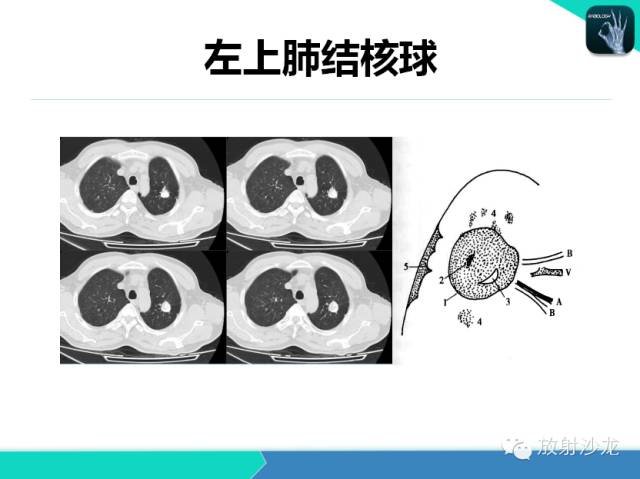 【PPT】肺结核影像学诊断