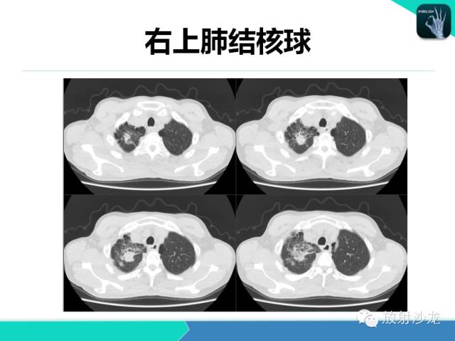 【PPT】肺结核影像学诊断
