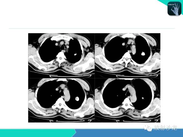 【PPT】肺结核影像学诊断