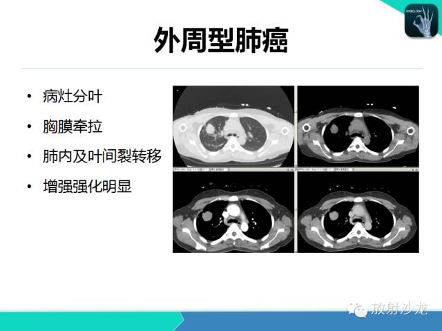 【PPT】肺结核影像学诊断