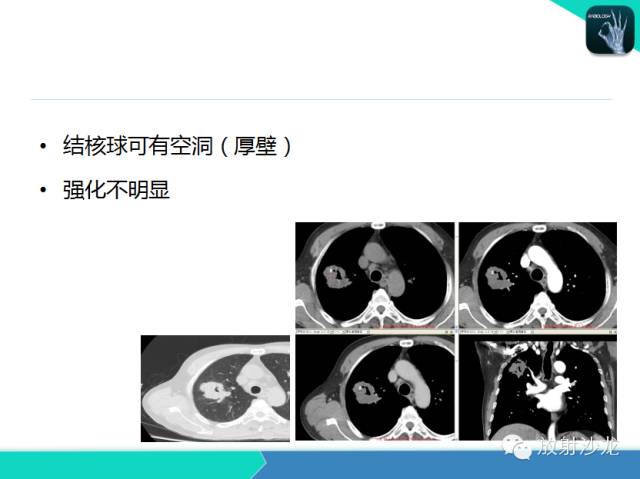 【PPT】肺结核影像学诊断