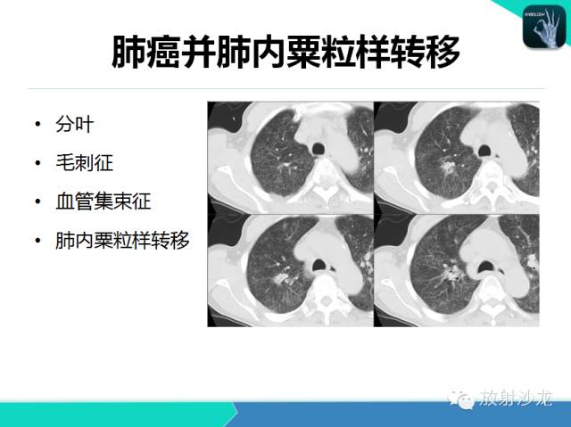 【PPT】肺结核影像学诊断