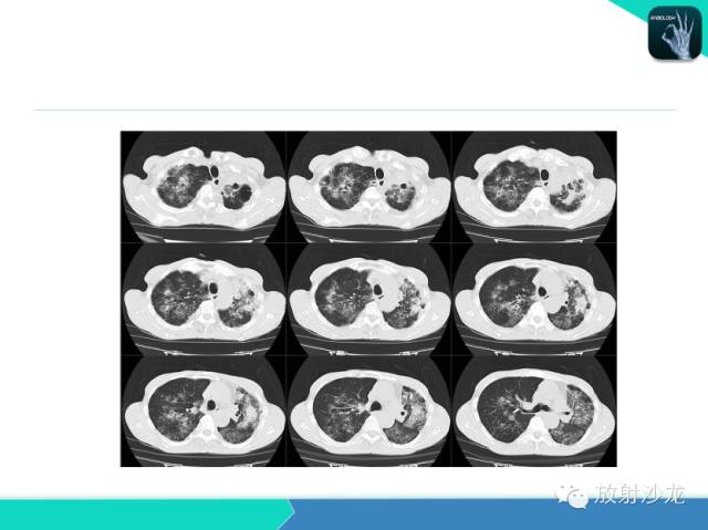 【PPT】肺结核影像学诊断